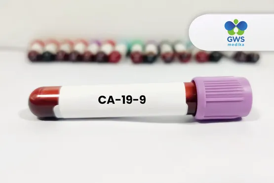 Tes CA 19-9 - Penanda Kanker Pankreas
