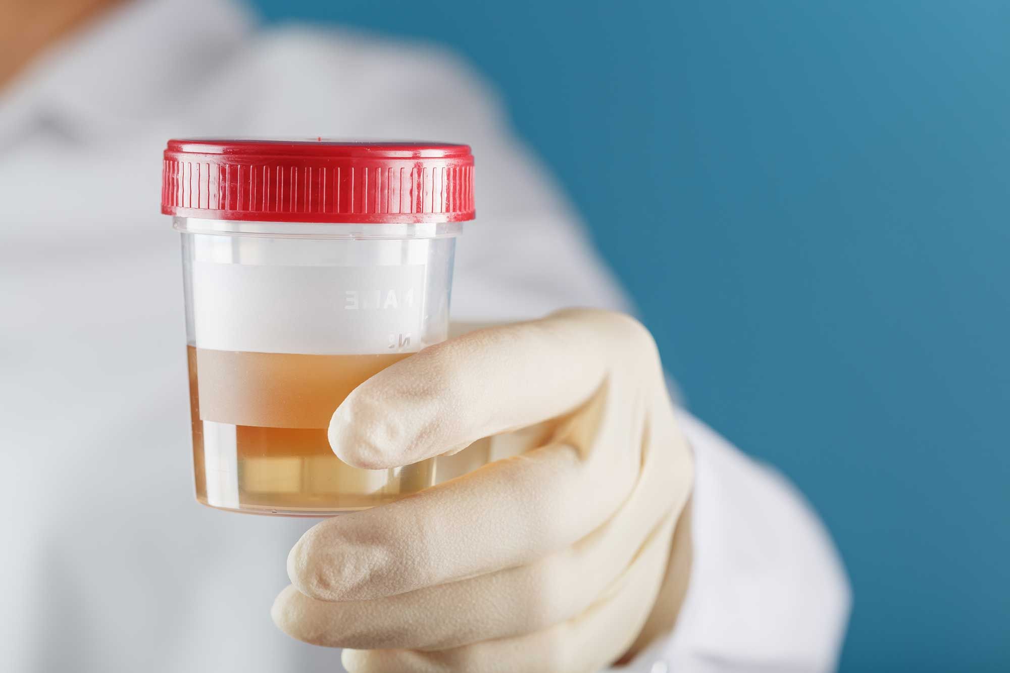 HPV Urine