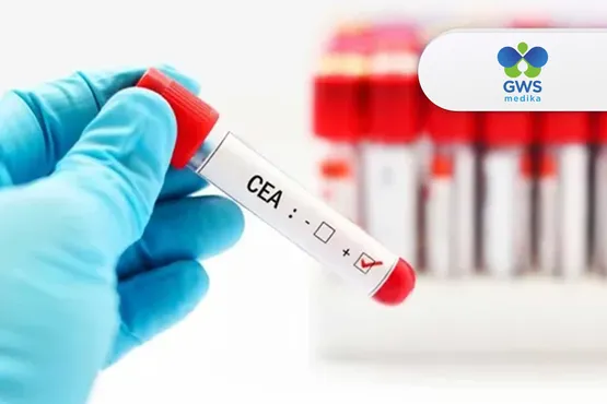 Tes CEA - Penanda Tumor Umum
