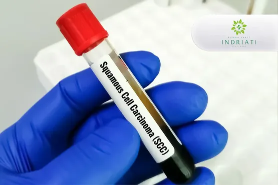 SCC (Squamous Cell Carcinoma)