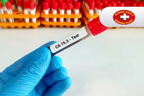 CA15-3 (cancer antigen 15-3)