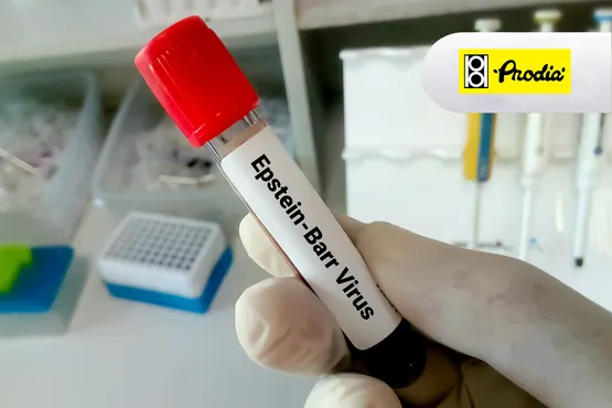 Epstein-Barr Virus Early Antigen IgA Antibodi