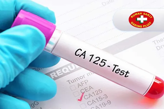 CA 125 (cancer antigen 125)