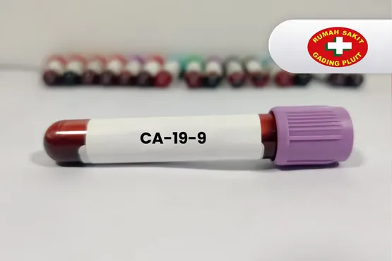 CA19-9 (cancer antigen 19-9